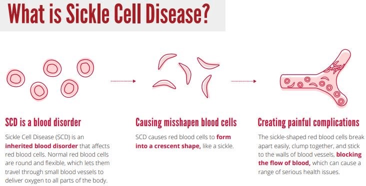 what is sickle disease
